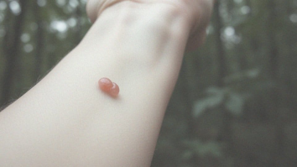 Czy czerwony bąbel po kleszczu jest oznaką infekcji?